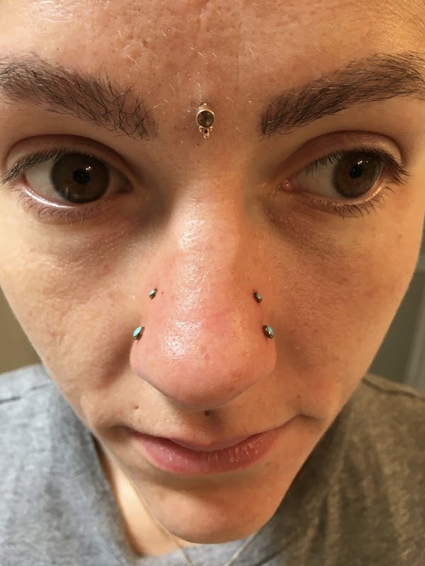 11.Michael, Double Nostril Piercing, Double High Nostril Piercings, Third Eye Dermal Anchor, Nostril Jewelry by Neometal, Anchor Jewelry by Zadamer Jewelry